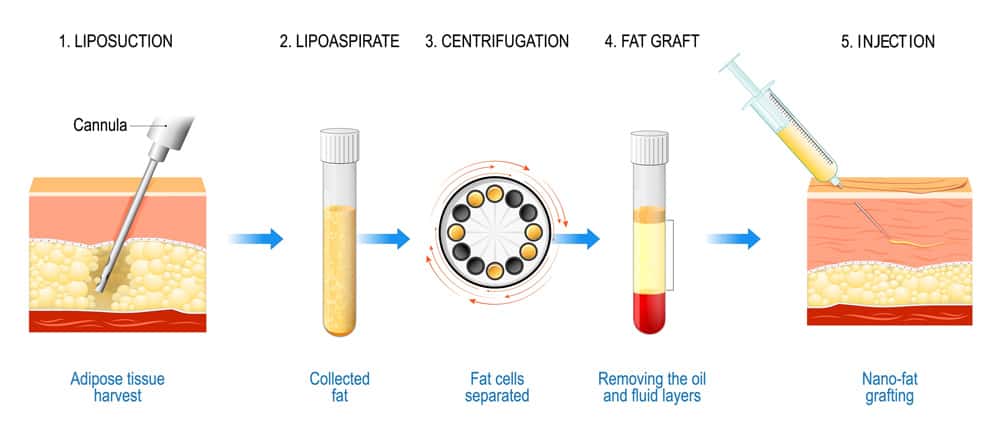 autologous-fat-injections