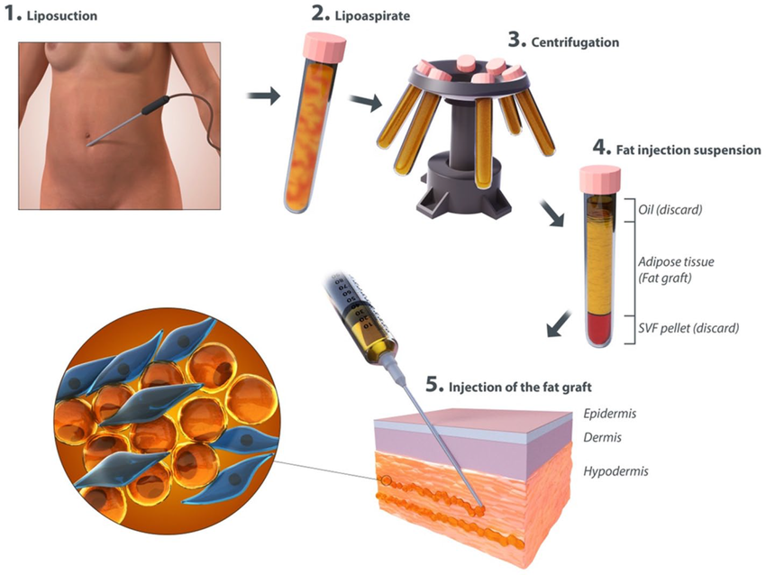 Autologous Fat Injections