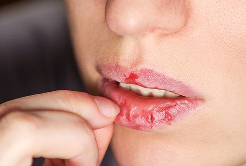 Avoid peeling your lips after filler injection