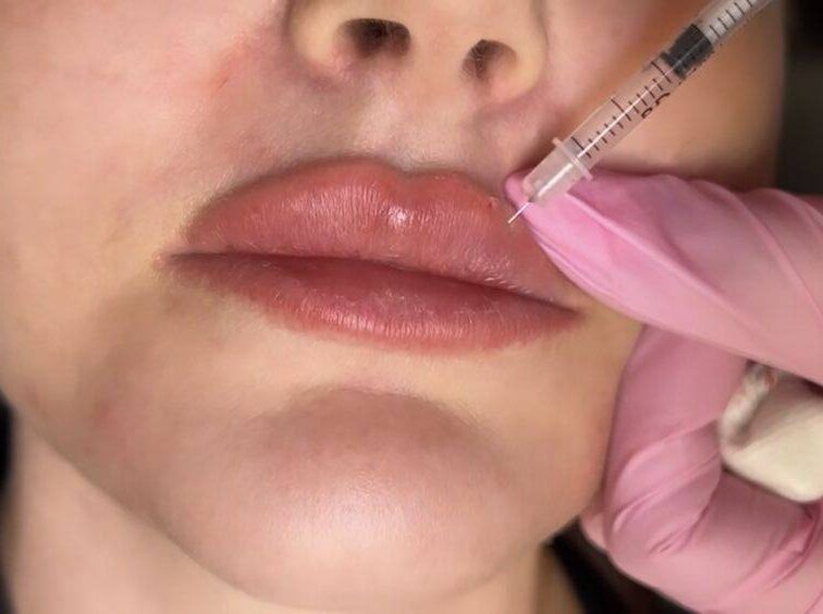 lip filler injection points