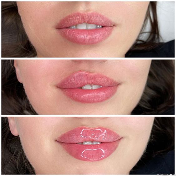 Baby Doll Lip Filler