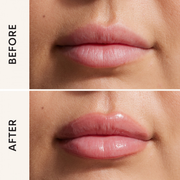 Baby Lip Filler before after