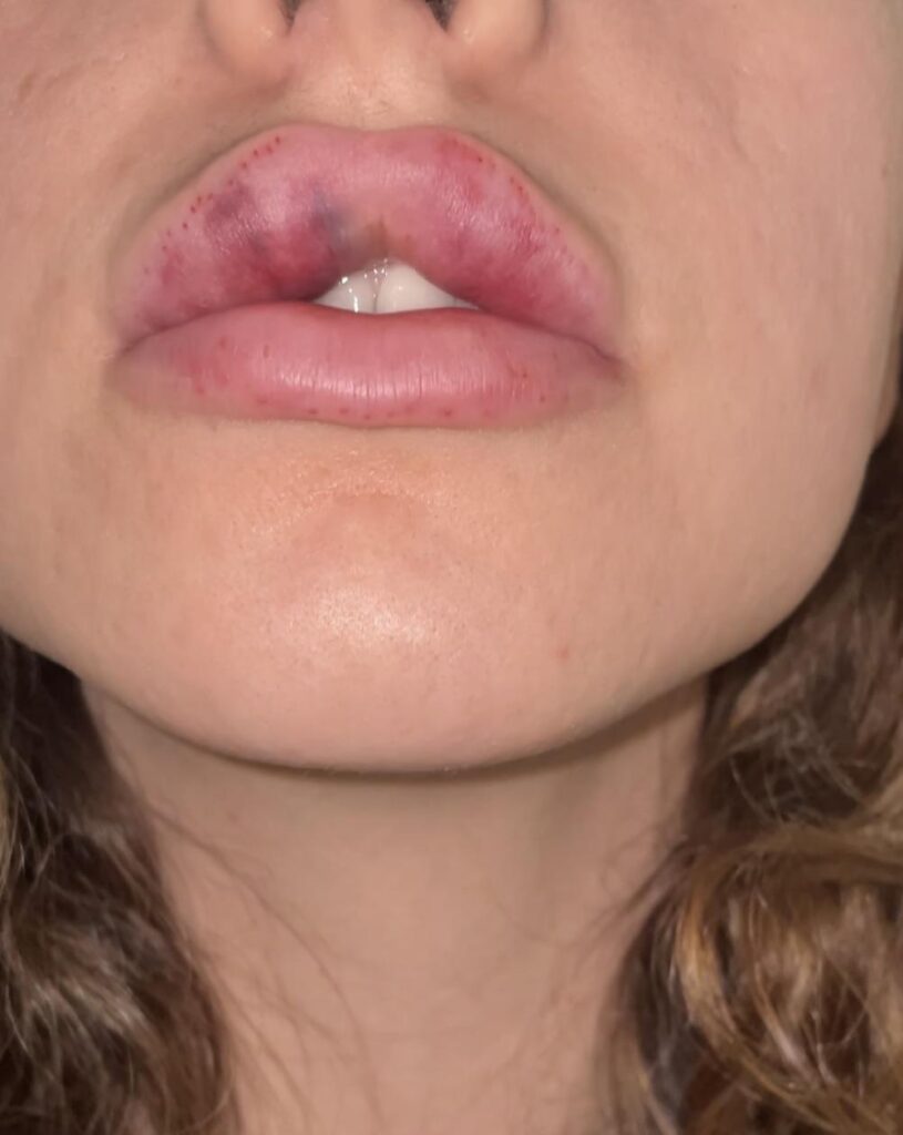 bad-lip-filler-bruising