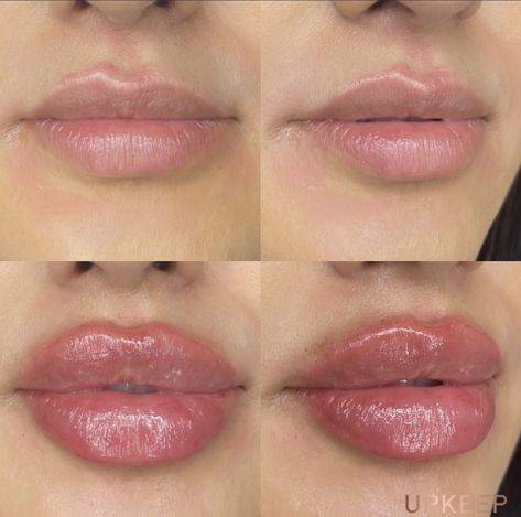 before and after juvederm lips