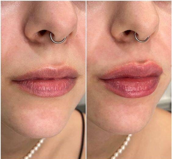 before and after juvederm lips