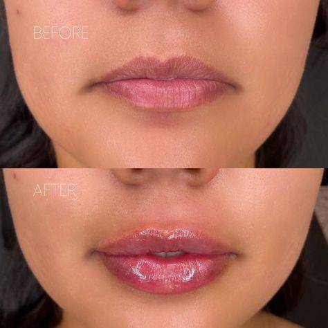 before and after juvederm lips