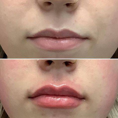 before and after juvederm lips