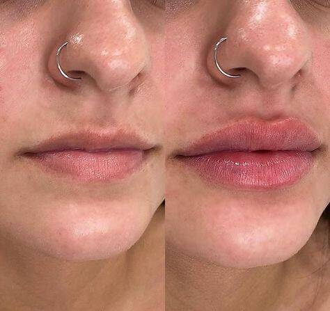 before and after juvederm lips