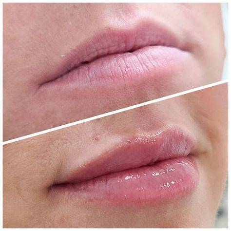 before and after juvederm lips