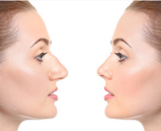 Before and After Nose Thread Lift