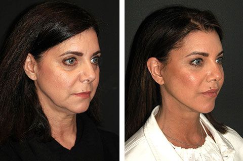 Before and After Photos of Horizontal Eyebrow Lift with Botox