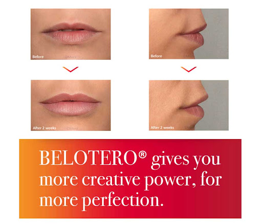 belotero lips before and after