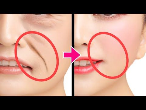 Benefits of 1 ml Filler