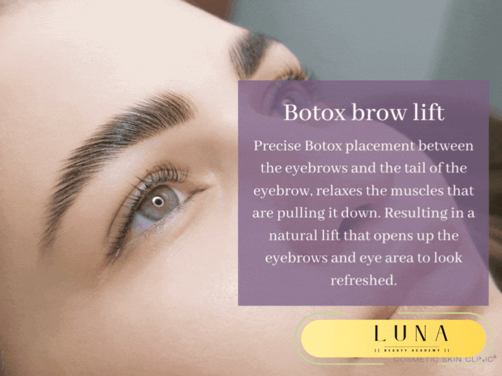 Benefits of a Brow Lift with Botox