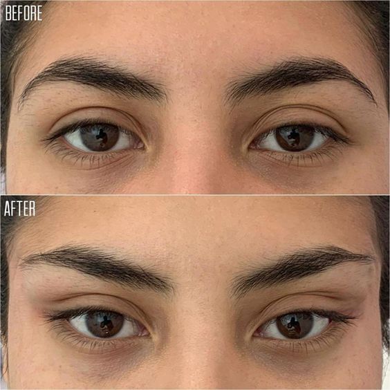 Benefits of a Fox Eye Thread Lift