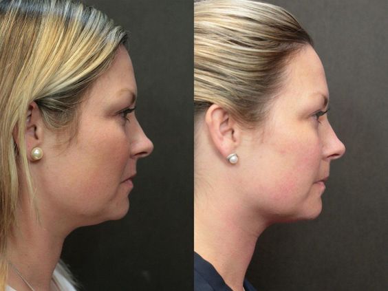 Benefits of Mesotherapy for Double Chin