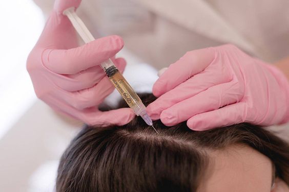 Benefits of Mesotherapy for Hair