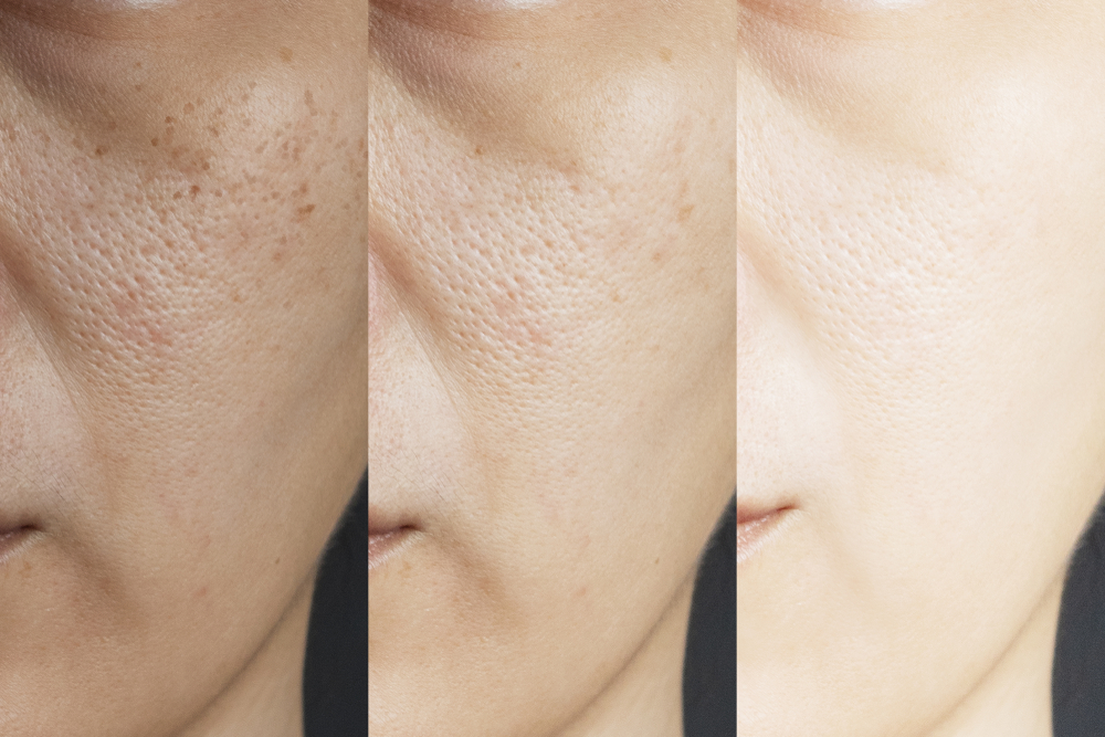 Visible results after Skin Whitening Injections