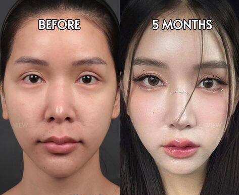 botox before after