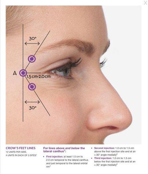 botox before and after crow's feet