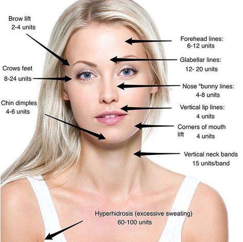 botox before and after crow's feet