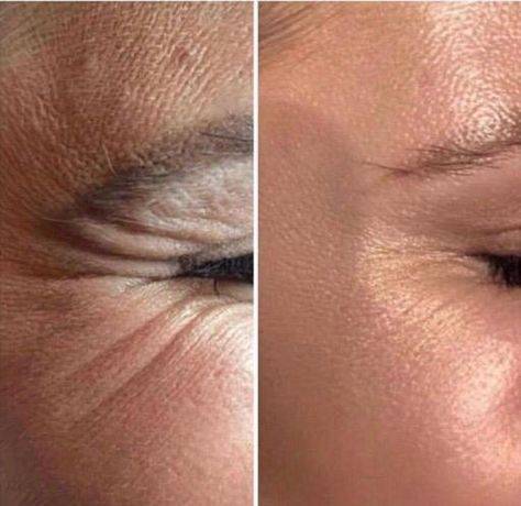 botox before and after crow's feet