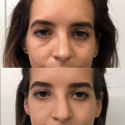 botox before and after eyes