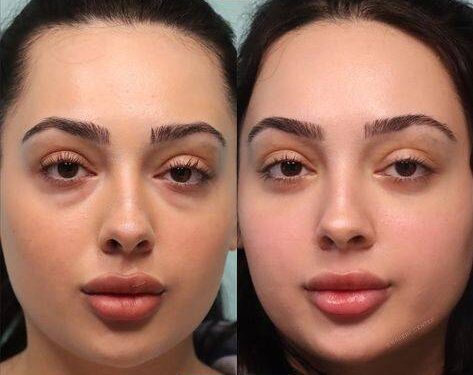 botox before and after eyes