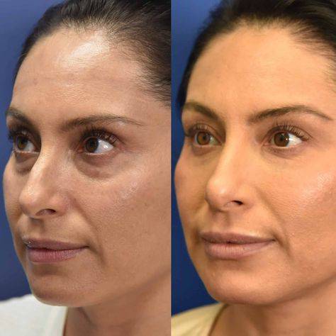 botox before and after eyes