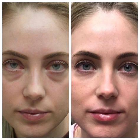 botox before and after eyes