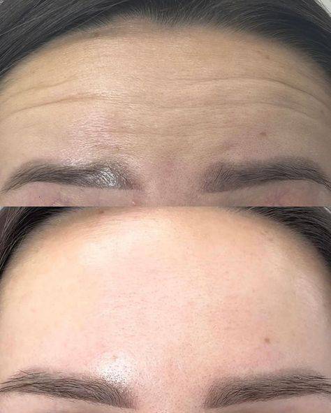 botox before and after forehead