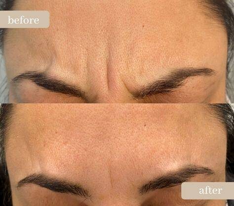 botox before and after forehead