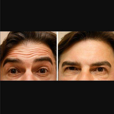 botox before and after forehead