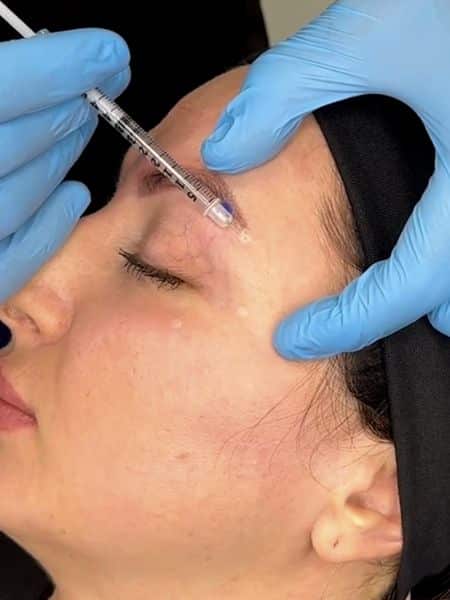 Botox Brow Lift