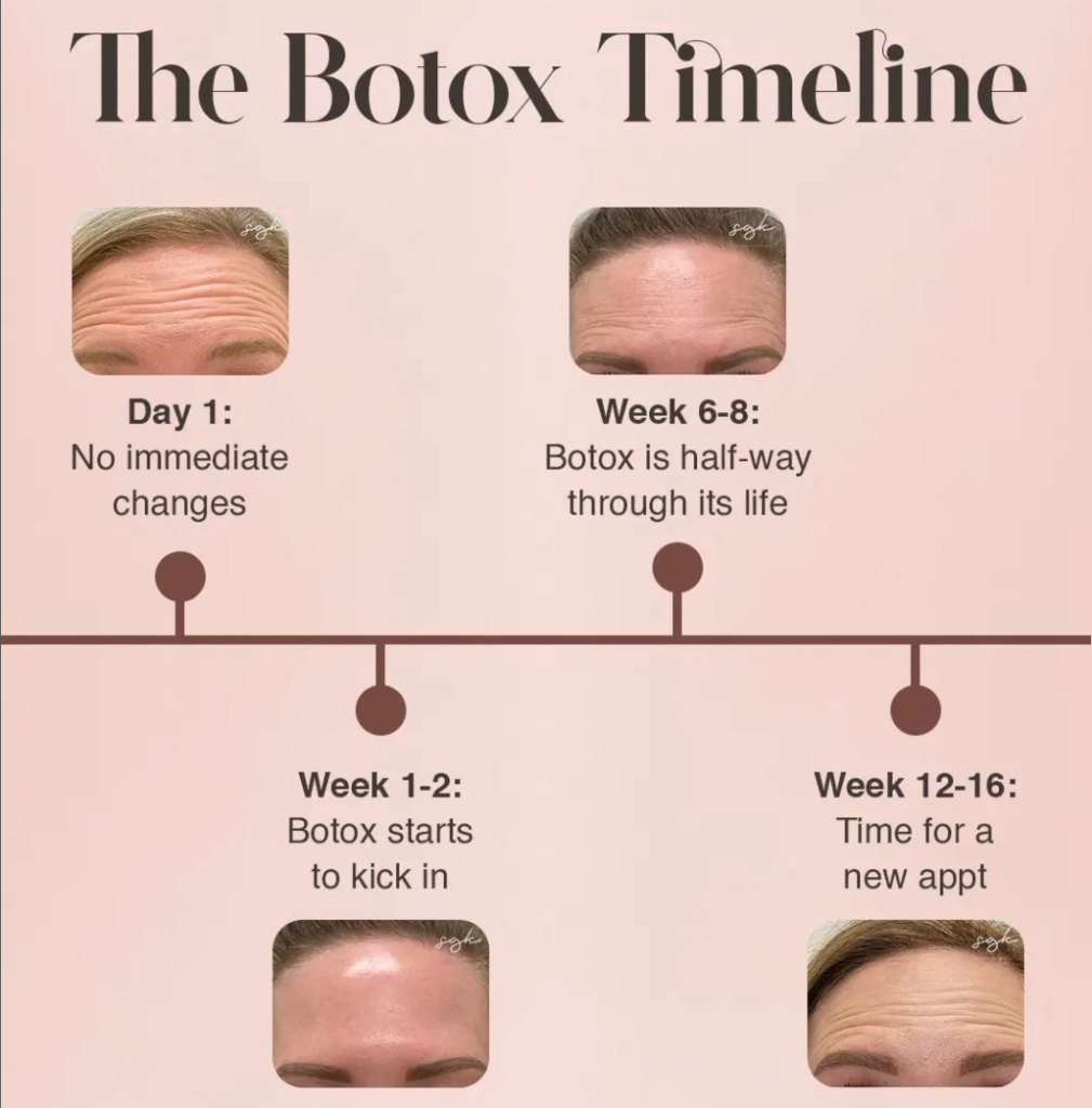 botox brow lift before and after results typically last between 3 to 6 months