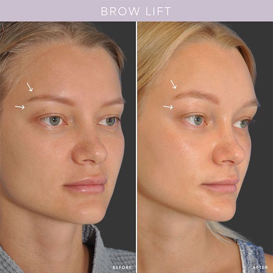 botox brow lift before and after