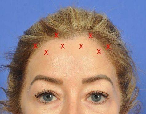 botox brow lift