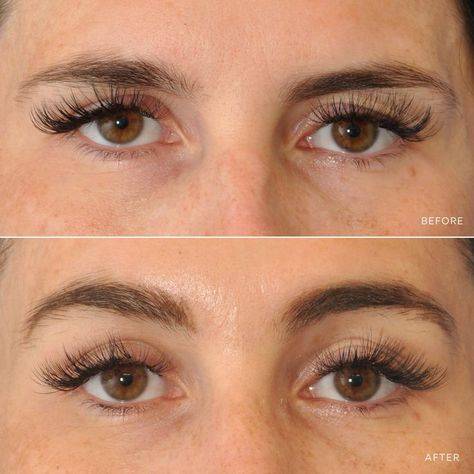 botox brow lift