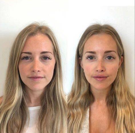 botox brow lift