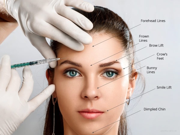 Botox Brow Lift Technique