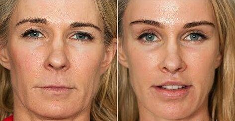 botox eyebrow lift before and after