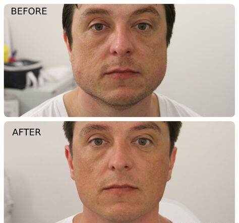 botox facial slimming