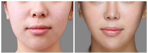 botox facial slimming