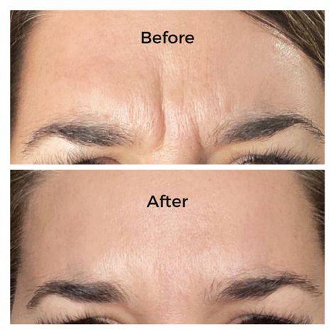 botox for forehead wrinkles