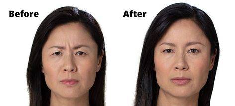 botox for forehead wrinkles