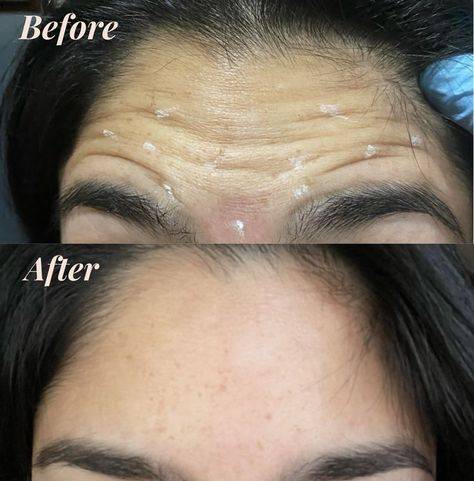 botox for forehead wrinkles