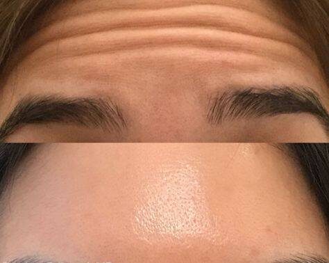 botox for forehead wrinkles