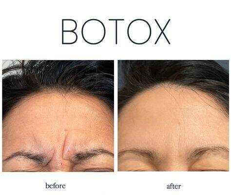 botox for forehead wrinkles