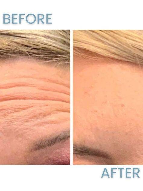 botox for forehead wrinkles