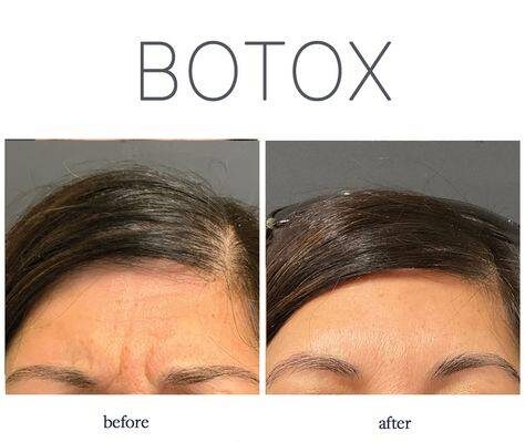 botox for forehead wrinkles